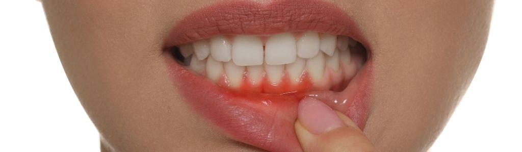 Diş Kökü İltihabı Tedavisi