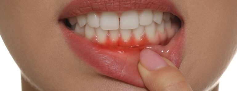 Diş Eti Temizliği Nasıl Yapılmalı, Diş Eti Tedavisi Detayları